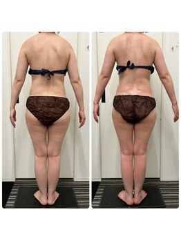 テラピ 藤江店/【痩身】肩甲骨を正しい位置に◎