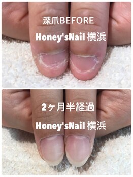 ハニーズネイル(Honey's Nail)/美爪育成施術前→2ヶ月半経