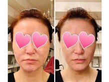 ヒーリングユー(Healing you)/４０代１回目のビフォーアフター