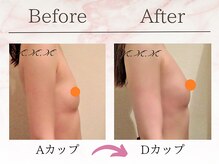 エムエムエム 表参道Luxeサロン(M.M.M)/【バストアップ例】　A→Dカップ