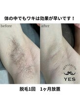 イエス 久留米店(YES)/ワキ脱毛ビフォーアフター