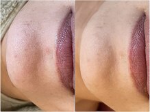 レスイズモア 恵比寿(less is more.)/一度の変化[ピーリングのみ]