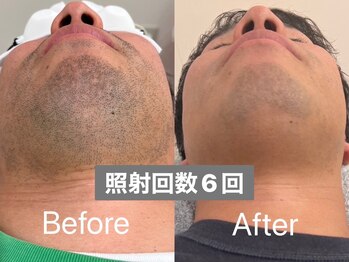 ラトリエ(L'Atelier)/ヒゲ脱毛6回 ビフォー/アフター