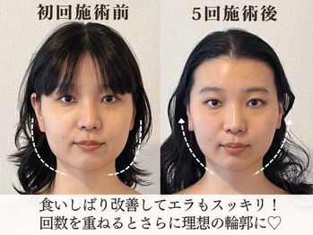 サロンキャン(Salon.CAN)/エラ食いしばり本格改善コース