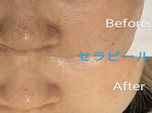ホロホロ(holoholo)/セラピール☆ビフォーアフター１