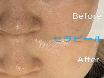 ホロホロ(holoholo)/セラピール☆ビフォーアフター1