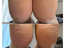 カシェット 広島店(Cachette)/40代女性☆足裏角質ケア60分