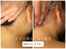 リノ(Lino)/うなじ脱毛シェービング付♪