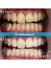 【人気No1】ホワイトニング8回+1回分ホワイトニングプレゼント(計9回)