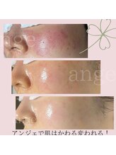 アンジェ(ange)/美肌ラボange式肌管理４か月☆