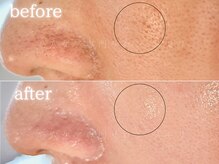 メモリ/お客様の変化/毛穴ケア