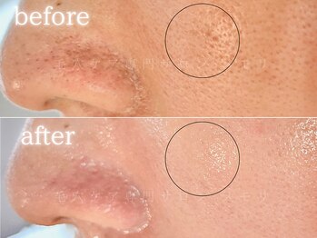 メモリ/お客様の変化/毛穴ケア