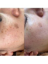 ミーミー 多治見店(MeMe.)/シミケア