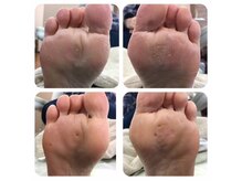 厚木 海老名 巻き爪矯正センター/事例【ドイツ式フットケア】