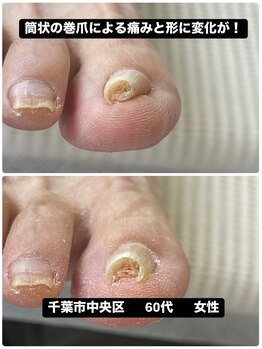 巻き爪じゅん 千葉駅前店/筒状の巻爪の痛みが改善！