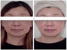 ホロホロ(holoholo)/頭蓋骨小顔矯正ビフォーアフター