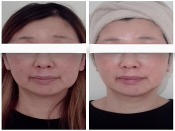 ホロホロ(holoholo)/頭蓋骨小顔矯正ビフォーアフター