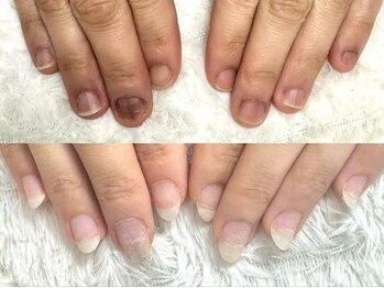 グラシナ なんば店/深爪/自爪育成/フィルイン