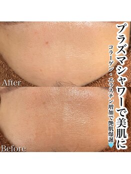 ベルファーム(Belle Femme)/プラズマシャワーでで美肌ケア☆