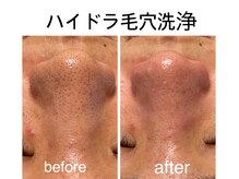クリソレース(Chrysolace)の雰囲気（美容液でお肌を洗う毛穴洗浄。脱・黒ずみ毛穴、ザラつき、卵肌へ）
