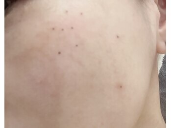 アグライア(Aglaea)/シミケア/after