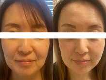 サクラ 本厚木駅前店(SAKURA)/シミケア/たるみケア/小顔/美肌