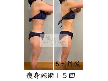 アイ エステサロン(Ai)/【50代後半】体が薄くなった♪