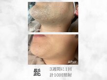 ベル(Belle)/メンズヒゲ脱毛