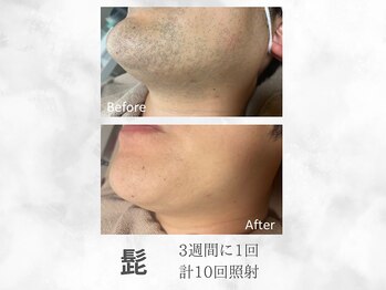 ベル(Belle)/メンズヒゲ脱毛