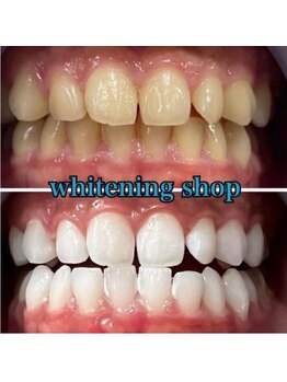 ホワイトニングショップ 越谷せんげん台店/Before After
