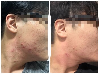 サリーエミリー 船橋店(SallyEmiry)/ハーブの計12回の効果です★