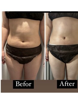 アヌヘア(Anuhea)/インディバ術ケア