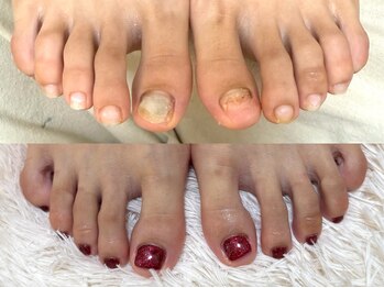 グラシナ なんば店/深爪/自爪育成/フィルイン