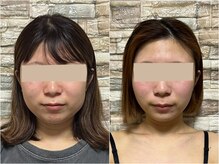 アゴラ/【小顔矯正】【小顔マシーン】