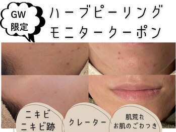 ジプソフィラフィフティドット(gypsophira15.)の写真/ノンケミカル・国産・他とは違う剥けるだけが目的ではないハーブピーリングで繰り返すお悩みにさよならを
