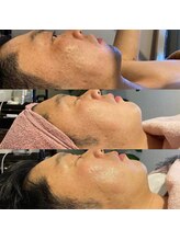 ミーティット(Meetite)/VOSサロンケア