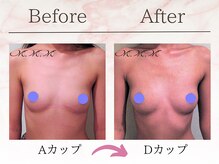エムエムエム 表参道Luxeサロン(M.M.M)/【バストアップ例】　A→Dカップ