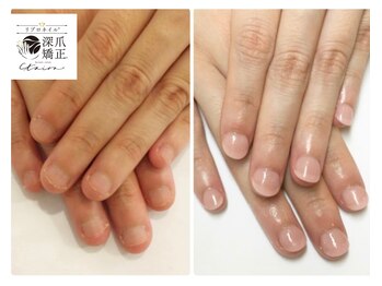 トイロ(toiro)/結果重視の深爪矯正