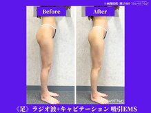 フェレザ 新潟(Felleza)/キャビテーション