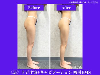 フェレザ 新潟(Felleza)/キャビテーション