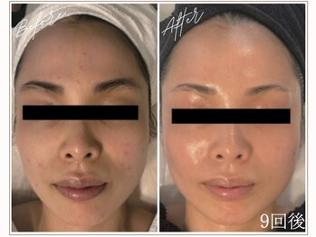 ミューベル(MYubelle)/水光肌 水光ピーリング肌質改善