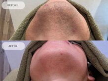 メンズプラス(MEN’S PLUS)/ヒゲ脱毛/ビフォーアフター写真