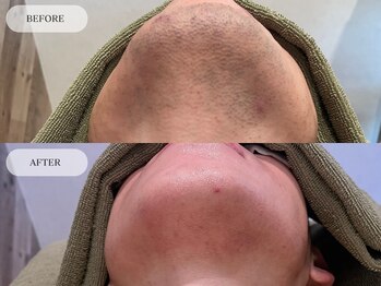 メンズプラス(MEN’S PLUS)/ヒゲ脱毛/ビフォーアフター写真