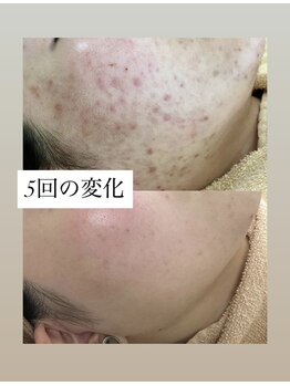 スキンプローズ(skinprose)/お顔のハーブピーリング・ハード