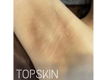トップスキン 名駅(TOPSKIN)/脇の黒ずみも撃退!ボディケア◎