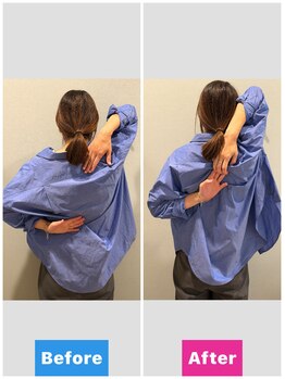 フィロ柏整骨院(Philo柏整骨院)/肩甲骨はがし Before After