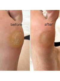 角質ケアも得意