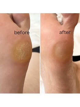 ニマ(nima)/タコ魚の目角質ケア　潤う足裏