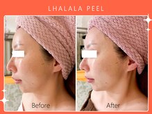 ハノハノ 八代店(HANO HANO)/韓国肌管理ララピール☆