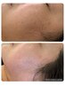 【しみケア・くすみ改善】透明感溢れる艶肌へ♪幹細胞ケア 14500→